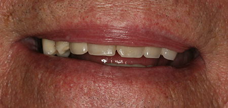 Case six before smile enhancement
