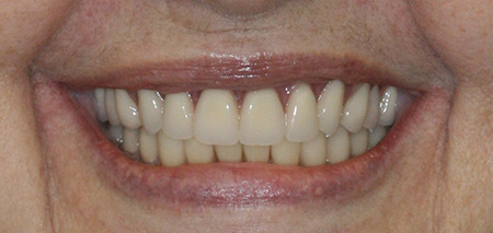 Case One after rehabilitation