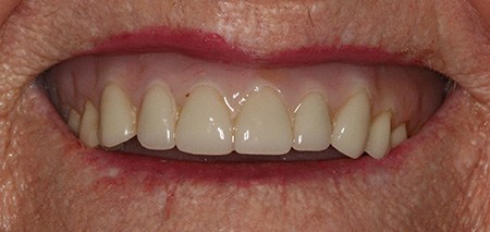 Case Four before smile enhancement