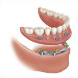 Implant overdenture bar